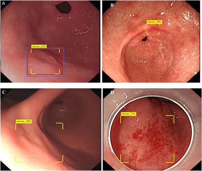 A system based on deep convolutional neural network improves the detection of early gastric cancer